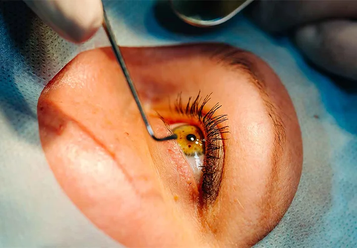 Retinal detachment Surgery